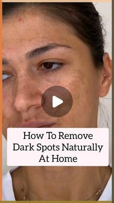 How To Remove Dark Spots On Skin, Fading Cream Dark Spots, Diy For Dark Spots On Face, How To Get Rid Of Brown Spots On Face, Face Darkness Removal, How To Reduce Dark Spots On Face, How To Remove Dark Spots On Face At Home, Removing Dark Spots On Face, Home Remedies For Dark Spots