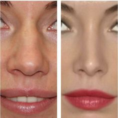 Nose Reduction, Nose Reshaping, Face Surgery