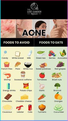 Want to fight acne through your diet? Find out the foods you should avoid and the ones you should include for healthier, acne-free skin. Visit our online shop for acne-fighting products and achieve clear skin! Food For Acne, Foods For Clear Skin, Clear Skin Diet, Acne Diet, Skin Diet, Acne Free Skin, Food To Eat, Clear Healthy Skin, Natural Acne