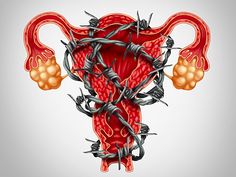 Uterus Art, Diet Help, Warning Signs, Statistics, 40 Years, Health Tips, Surgery, Disease