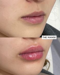 Nose Fillers, Lip Flip, Beauty Skin Quotes, Korean Lips, Honey Brown Hair