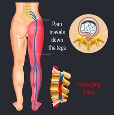 the diagram shows how pain travels down the legs and fixing disks on each leg