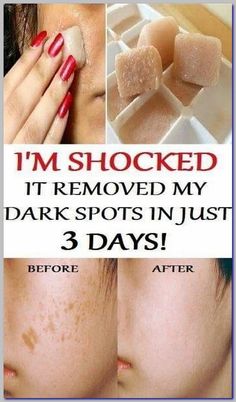 It Removed My Dark Spots and Made my Skin Clearer Potato Juice, Wrinkle Free Skin, Wrinkle Remover, Simple Tricks