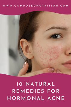 In this post you’ll learn about natural remedies for hormonal acne! Learning about remedies for hormonal acne is one way to balance estrogen, progesterone, and testosterone. Find more acne remedies and hormone balancing tips at composednutrition.com. Remedies For Hormonal Acne, Period Remedies, Cortisol Reduction, Period Cramp Relief, Balance Diet, Fertility Nutrition, Wedding Skincare