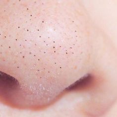 If you’ve ever suffered a smattering of blackheads that just don’t clear away, take a closer look. You might not be dealing with blackheads at all, but sebaceous filaments instead. Learn all about what separates these spots. Black Heads On Nose, Nose Blackheads, Sebaceous Filaments, Pimple Cream, Home Remedies For Pimples, Blackheads On Nose, Eminence Organic Skin Care, Pimples Remedies