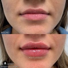 Lips Injection, Russian Lip Filler, Pump Lips, Lip Fillers Juvederm, Russian Lips, Facial Aesthetics