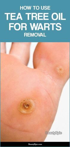 What Causes Warts, Remove Warts, Wart Remover, Clean Baking Pans, Cleaning Painted Walls, Get Rid Of Warts, Deep Cleaning Tips, Natural Cold Remedies, Cold Remedies