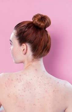 Fix your bacne with Truly Beauty's easy-to-use Bacne Routine! Remedies For Back Acne, Acne Pictures, Back Acne Remedies, Cystic Acne Remedies, Congratulations Images, Truly Beauty, Chest Acne, Back Acne, Best Instagram Feeds