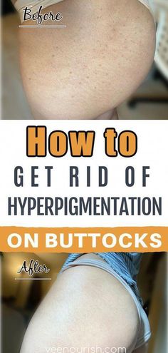 Buttocks Acne, Get Rid Of Hyperpigmentation, Pimples On Buttocks, Skin Natural Remedies, Cold Sores Remedies