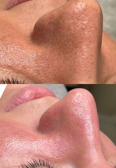 Hydrafacial Before And After, Facial Routines