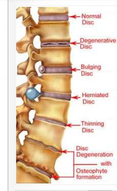 Natural Headache, Muscle Anatomy