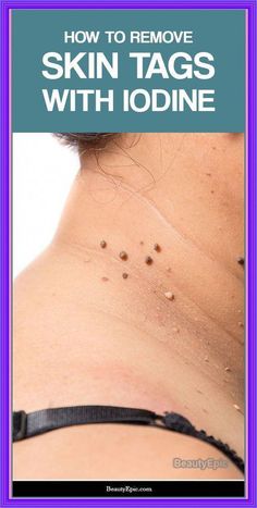 How to Remove Skin Tag in 1 NIGHT! by dalers minore | This newsletter was created with Smore, an online tool for creating beautiful newsletters for educators, businesses and more Skin Rash Remedies, Rash Remedies, Eye Exercises, Weight Changes, Sleep Remedies