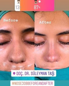 Rhinoplasty Bulbous Nose, Bulbous Nose Job Before And After, Thick Nose Rhinoplasty, Thick Skin Bulbous Tip Rhinoplasty, Nose Job Thick Skin, Thick Skin Nose Job, Rhinoplasty Before And After Bulbous, Nose Job Before And After Bulbous, Thick Skin Rhinoplasty