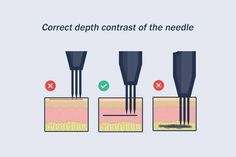 three different types of needles are shown in this diagram, with the same type of needle