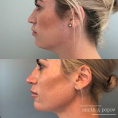 Lip Fillers Juvederm, Esthetician Career, Jawline Filler, Chin Reduction