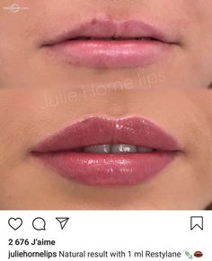 Lip Filler 5ml, Julie Horne Lip Filler, Small Lips Filler, M Shaped Lips With Filler, Lip Filler Pouty Lips, Natural Lip Filler Inspiration, Lip Filler Shape Ideas Natural, Lip Filler Inspo Natural, Natural Lip Fillers Small Lips