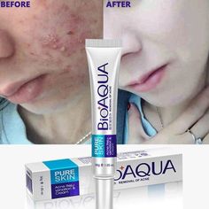 Blackheads Removal Cream, Acne Scar Cream, Fade Acne Marks, Scar Cream, Skin Lightening Cream, Acne Facial, Acne Cream, Face Acne, Body Sunscreen