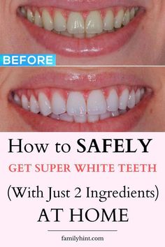 Whiten Teeth At Home