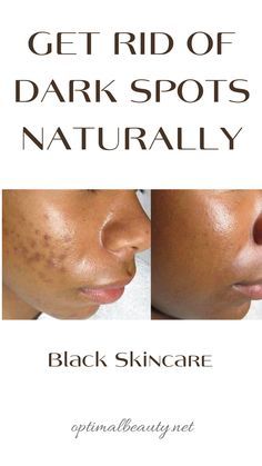 Black Skin Care Dark Spots, Bad Acne, Black Skin Care, Skin Remedies, Skin Care Recipes, Face Skin Care