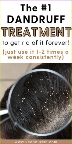 Tired of dandruff ruining your hair days? Discover the top 7 dandruff treatments that actually work to eliminate flakes and itchy scalp for good. Whether you're dealing with dry scalp or stubborn dandruff, these natural dandruff remedies and anti-dandruff shampoos will restore your scalp’s health and give you the confidence to flaunt your hair. Learn how to prevent dandruff, promote hair growth, and maintain a healthy scalp with these powerful hair care tips! Itchy Dry Scalp Remedy, Natural Remedies For Dandruff, How To Prevent Dandruff, Best Shampoo For Dandruff, Itchy Scalp Remedy, Natural Dandruff Remedy, Dandruff Solutions, How To Treat Dandruff, Home Remedies For Dandruff