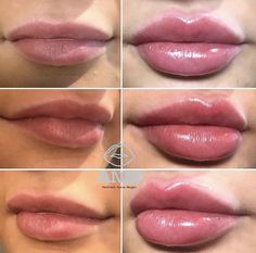 Lip Filler Shape Ideas, Cosmetic Fillers, Lip Types, Face Fillers