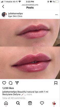 Juvederm Lips, Lip Permanent Makeup, Lip Augmentation