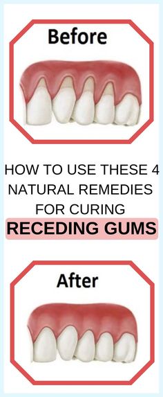 7 Natural Ways To Treat Receding Gums Strong Teeth, Healthy Teeth And Gums, Dental Health Care, Whiten Your Teeth, Teeth Health, Oral Care Routine, Green Food, Receding Gums, Gum Care