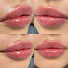 Allergan Botox, Lip Enhancement