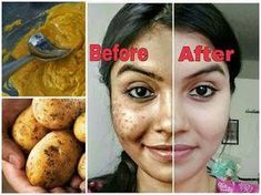 Got acne, dark spots, or skin rashes? Beauty vlogger Ishita Chanda outlines a method using something you probably already have in your kitchen: raw potato. Dark Spots On Skin, Body Acne, Deep Cleaning Tips, Natural Body, Uneven Skin Tone, Skin Problems, Dark Spots, Good Skin