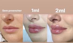 Under Eye Fillers, Facial Bones, Fake Lips