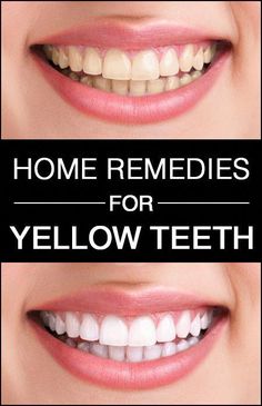 If you want to whiten your teeth naturally at home without the pain of visiting a dentist, keep reading. Check out these 7 effective and quick home remedies. Yellow Teeth, Astuces Diy, Oral Health Care, White Teeth, Tooth Decay, Oral Health