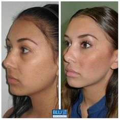 Eye Hollows, Under Eye Hollows, Beauty Enhancement, Chin Augmentation, Face Surgery, Botox Alternative