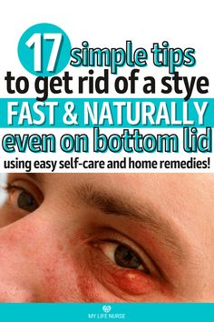 Fast and Natural Stye Remedies for Allergy-Related Styes Sty Remedy How To Get Rid, Sty In The Eye Remedies How To Get Rid, Get Rid Of A Stye Overnight, Stye Remedies Fast Essential Oils, Remedies For Stye On Eyelid, How To Get Rid Of Stye Eye, Sty Eye Remedies How To Get Rid, Natural Stye Remedies, Natural Remedies For Stye Eye