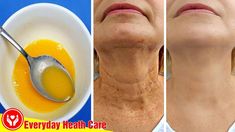 Just apply this remedy, you can Get Rid Of Neck Wrinkles and have healthier skin. It will help smooth, firm, and soften skin as well as to Get Rid Of Neck Wr... Neck Wrinkles Remedies, Face Wrinkles Remedies, Wrinkles Remedies Face, Home Remedies For Wrinkles, Mouth Wrinkles, Wrinkle Remedies, Natural Face Skin Care, Neck Wrinkles, Skin Care Wrinkles