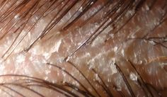 dandruff scalp behind ear Oily Dandruff Scalp, Dry Scaly Scalp, Scalp Scaler, Cat Dandruff, Sebboric Dermitis Scalp, Gross Anatomy, Close Up Pictures