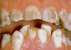 Abnormal Tooth Morphology | Pocket Dentistry Tooth Morphology, Rotten Teeth, Impacted Tooth, Cavities, Lips, Crown, Quick Saves, Color