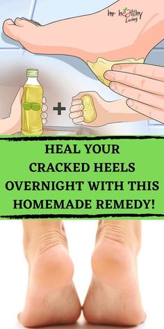 Cracked Feet Remedies, Cracked Heel Remedies, Foot Soaks, Flaking Skin, Cracked Heels, Homemade Remedies, Natural Health Remedies, Wellness Tips