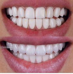 Perfect Teeth Smile, Dental Makeover, Grow Back Receding Gums, Whiten Teeth Fast, Pretty Teeth, Dental Videos, Veneers Teeth, Beautiful Teeth, Porcelain Veneers