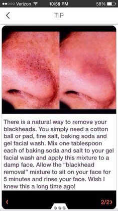 Acne Blackhead Remedies, Black Heads, Blackhead Removal, Beauty Remedies, Homemade Beauty Products, Facial Wash, Blackhead Remover, Health And Beauty Tips, Skin Tips