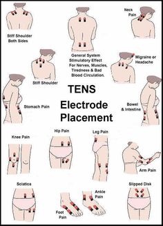 Tens Electrode Placement, Tens Unit Placement, Tens And Units, Tens Machine, Tens Unit, Ten Unit, Back Pain Remedies, Ankle Pain, Sciatic Nerve Pain