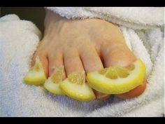 This Will DESTROY Toenail Fungus For Good! - YouTube Choppy Hairstyles, Toenail Fungus Remedies, Nail Fungus Remedy, Fungal Nail, Shaggy Bob, Pedicure At Home, Toenail Fungus, Nail Fungus, Nail Health