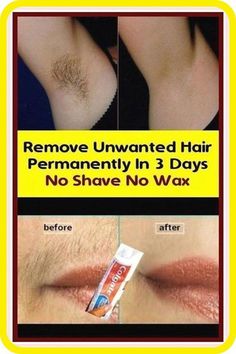 Best Permanent Hair Removal, Permanent Hair Removal Cream, Permanent Facial Hair Removal, Back Hair Removal, Leg Hair Removal, Electrolysis Hair Removal, Lip Hair Removal, Unwanted Hair Permanently, Best Hair Removal Products