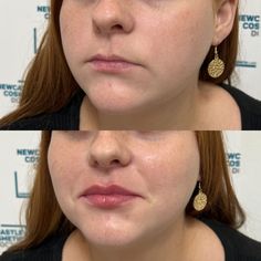 0.5ml lip filler Dermal Fillers Lips, Cosmetic Injectables, Newcastle Nsw, Injectables Fillers