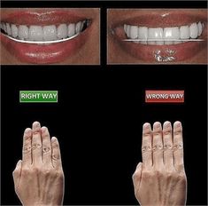 Teeth Makeover, Dental Pictures, Dental Posts, Dental Posters, Dental Aesthetics, Dental Videos, Kedokteran Gigi, Veneers Teeth, Dental Anatomy