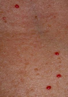 Cherry Angiomas (Campbell de Morgan spots). Iodine Deficiency, My Tattoo, Thyroid Health, Natural Health Remedies, Alternative Health, Health Info, Health And Beauty Tips, Health Facts, Natural Medicine