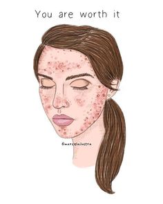 Body Positivity Art, Severe Acne, Beauty Illustration, Acne Skin, Insta Photo, You Are Beautiful