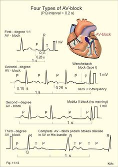 4 Types of AV-Block Ekg Interpretation, Paramedic School, Nurse Rock