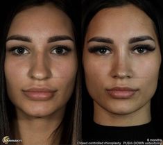 Nose Job Inspo, Nose Plastic Surgery, Ethnic Rhinoplasty, Rhinoplasty Surgery