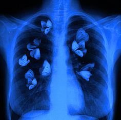 an x - ray image of the chest with butterflies on it