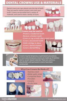 Dental Crowns will help you Dental Crown Procedure, Throat Health, Dental Infographics, Dental Assistant School, Dental Animation, Dental Assistant Study, Teeth Anatomy, Dental Nurse, Dental Materials